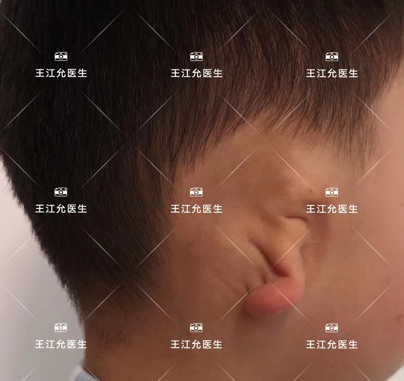 小耳畸形,伴随大小脸怎么办?