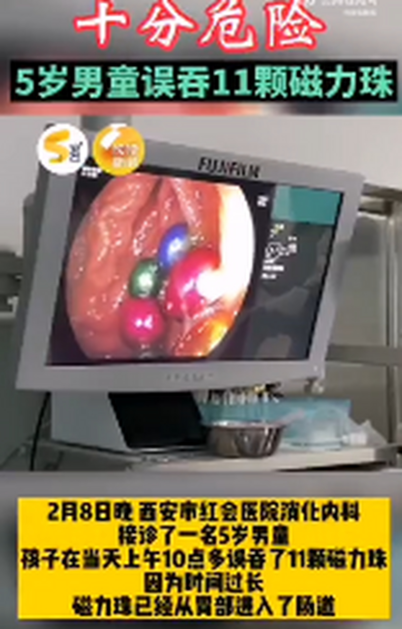 磁力珠吃到肚子里多久有反应=磁力珠误食3颗有排出来的案例吗?