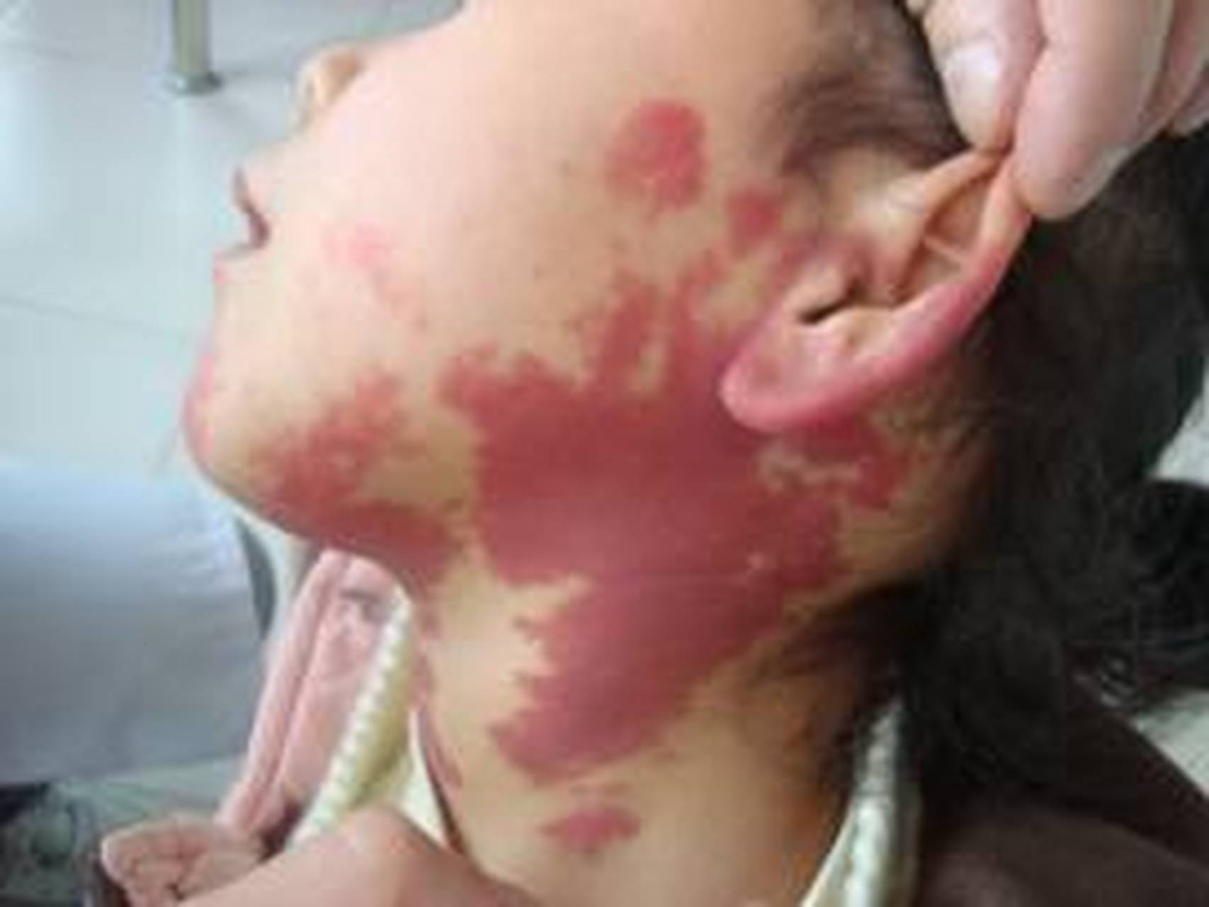 鲜红斑痣,俗称"红胎记又称葡萄酒样痣,葡萄酒色斑