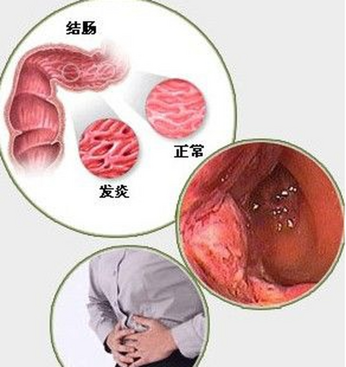 慢性肠胃炎的症状图片