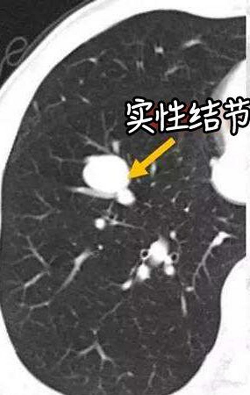 实性结节,变成囊性结节,是好还是不好!