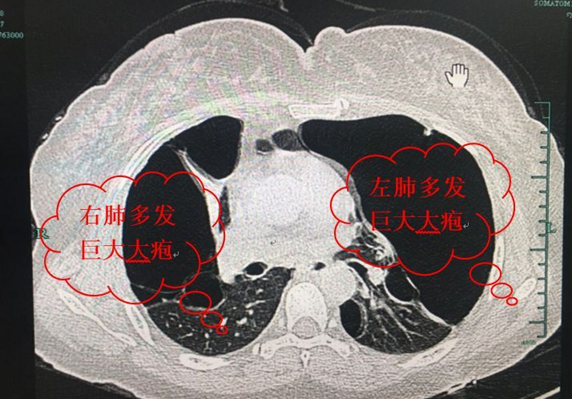 有些患者还在跟我问肺大泡,肺气肿,慢阻肺,是不是要戒烟戒酒!