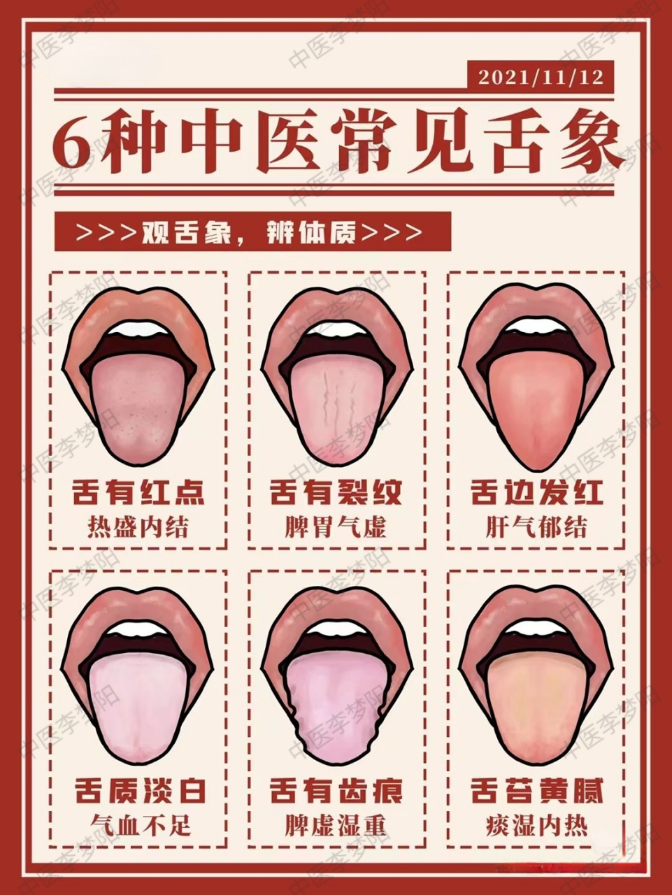 每日粉丝舌象分析  舌象:舌苔黄泥,舌质水滑,舌头两侧鼓胀上翘,中间