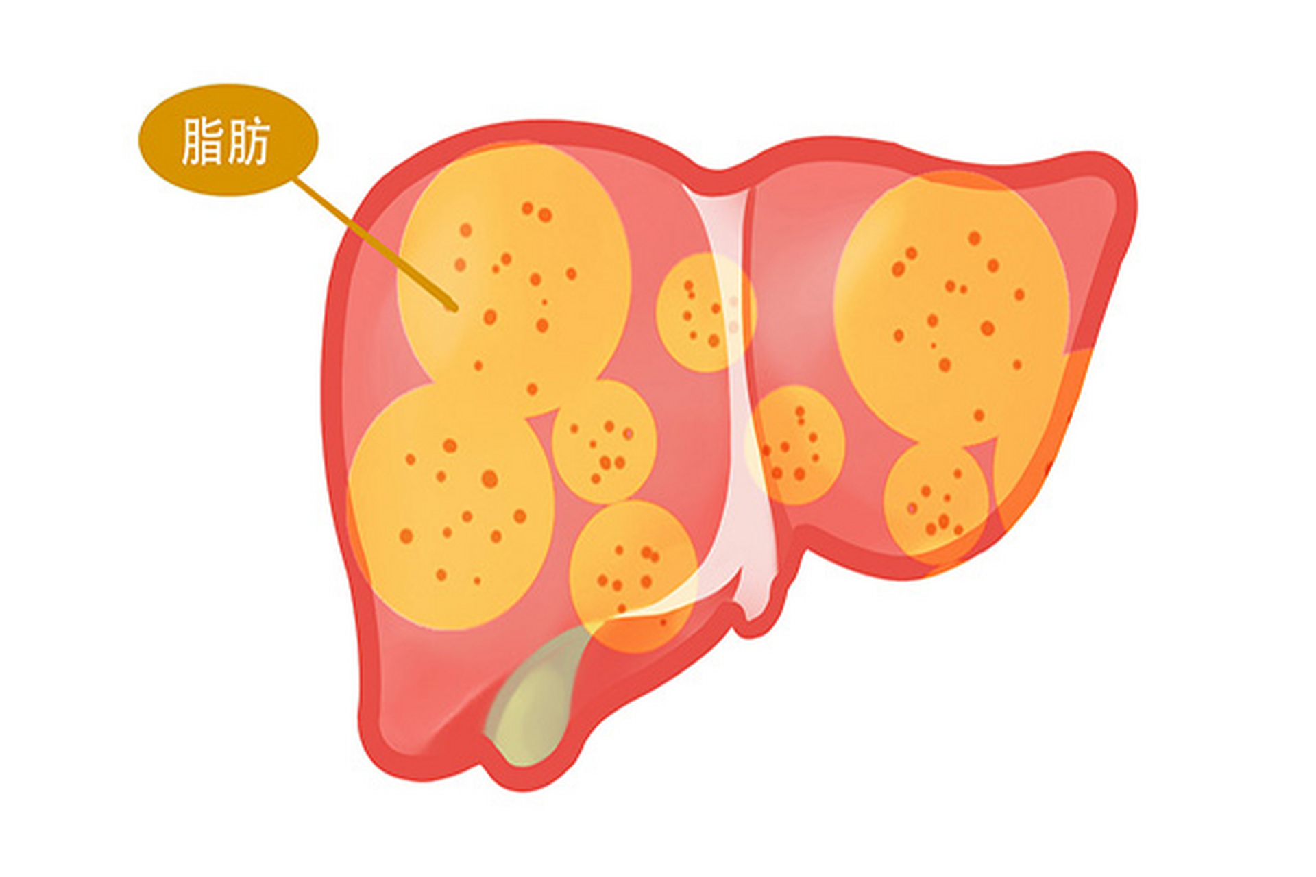 脂肪肝解剖图图片
