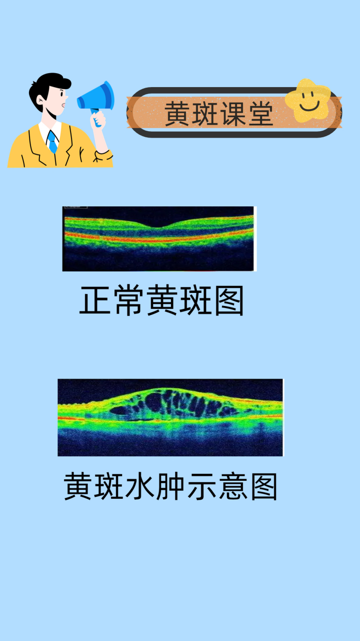 很多患者在患黄斑水肿后反复发作,长期注射针剂,后期发现特别影响