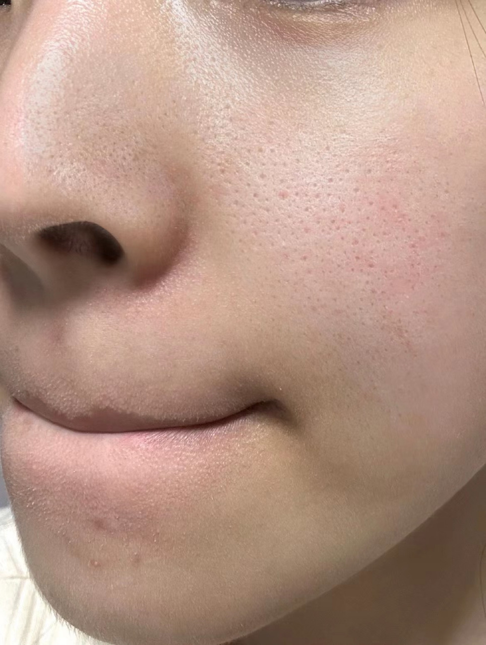 那么,毛孔粗大做微针好还是点阵激光好呢?