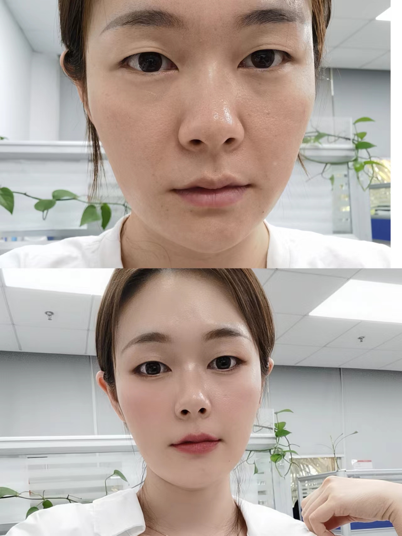 个人诉求 通过fotona来改善法令纹