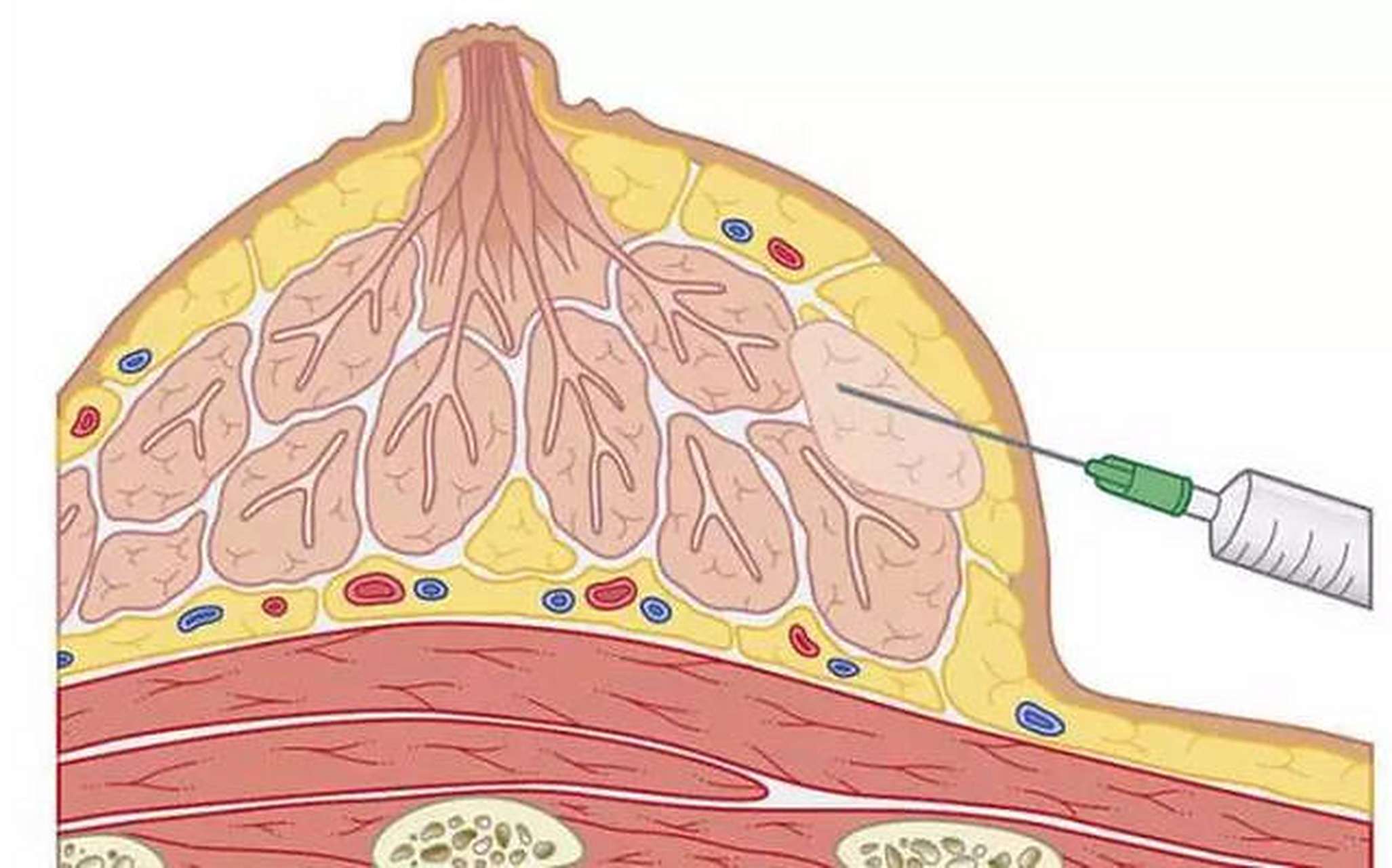 乳腺增生和乳腺纤维瘤有什么区别 乳腺增生:乳腺增生病的乳房肿块大多