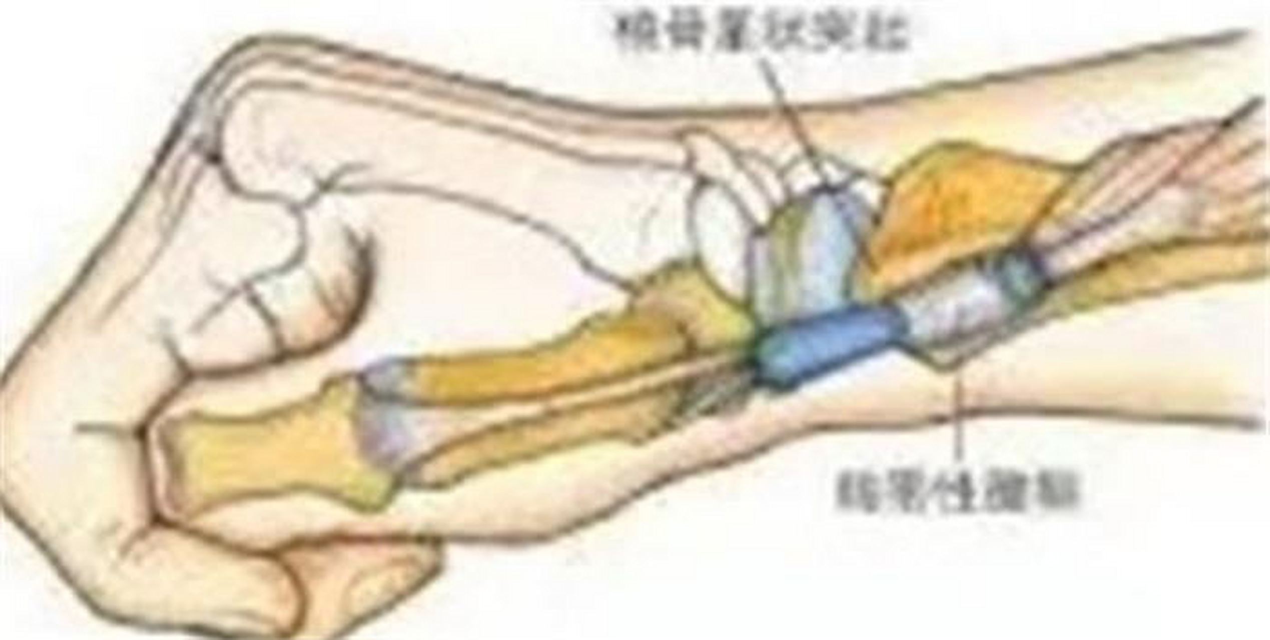 手腕背部腱鞘炎图片