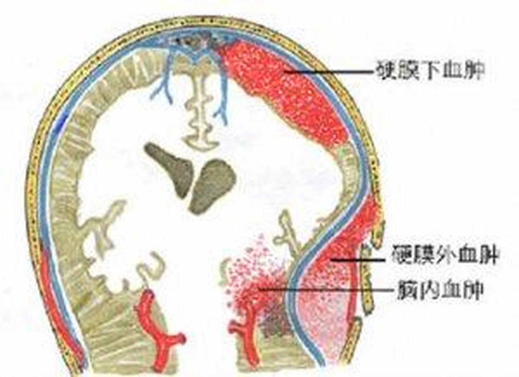 【颅内血肿按部位分为 1,硬脑膜外血肿:硬脑膜外血肿主要源于脑膜