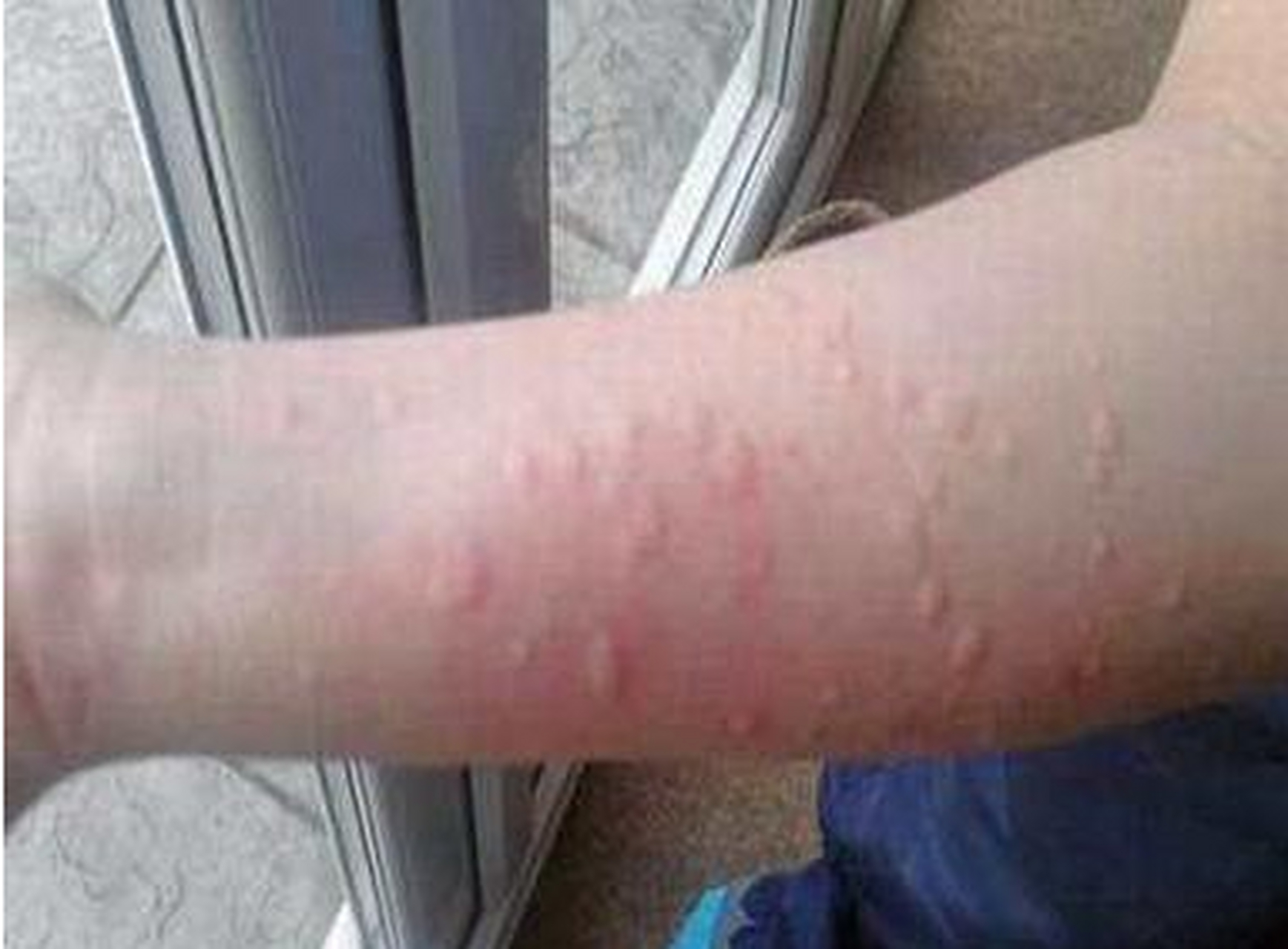 急性荨麻疹的病程一般在6周以内,一般有比较明确的致病诱因,并且积极