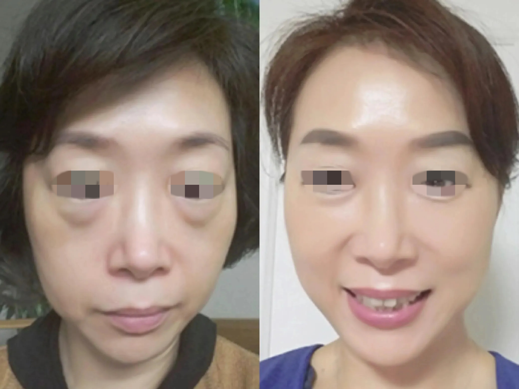 苹果肌复位,让我意识到,整形可以"走捷径"!