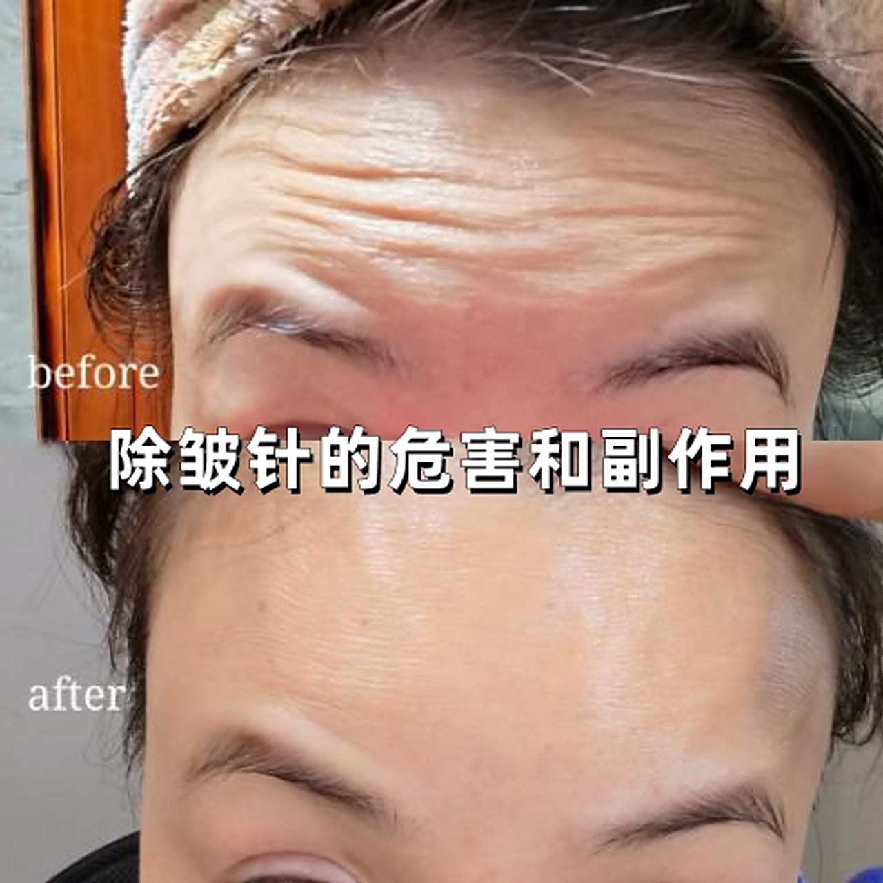 除皱针的危害和副作用  我看很多求美者都对除皱针很感兴趣,但是不太