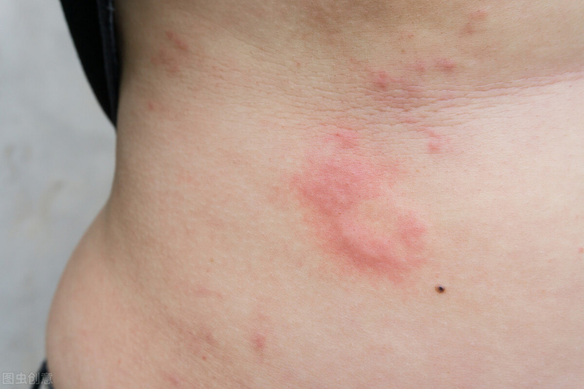 怎么快速辨别身上起的疹子是湿疹还是荨麻疹?  其实,辨别方法很简单!