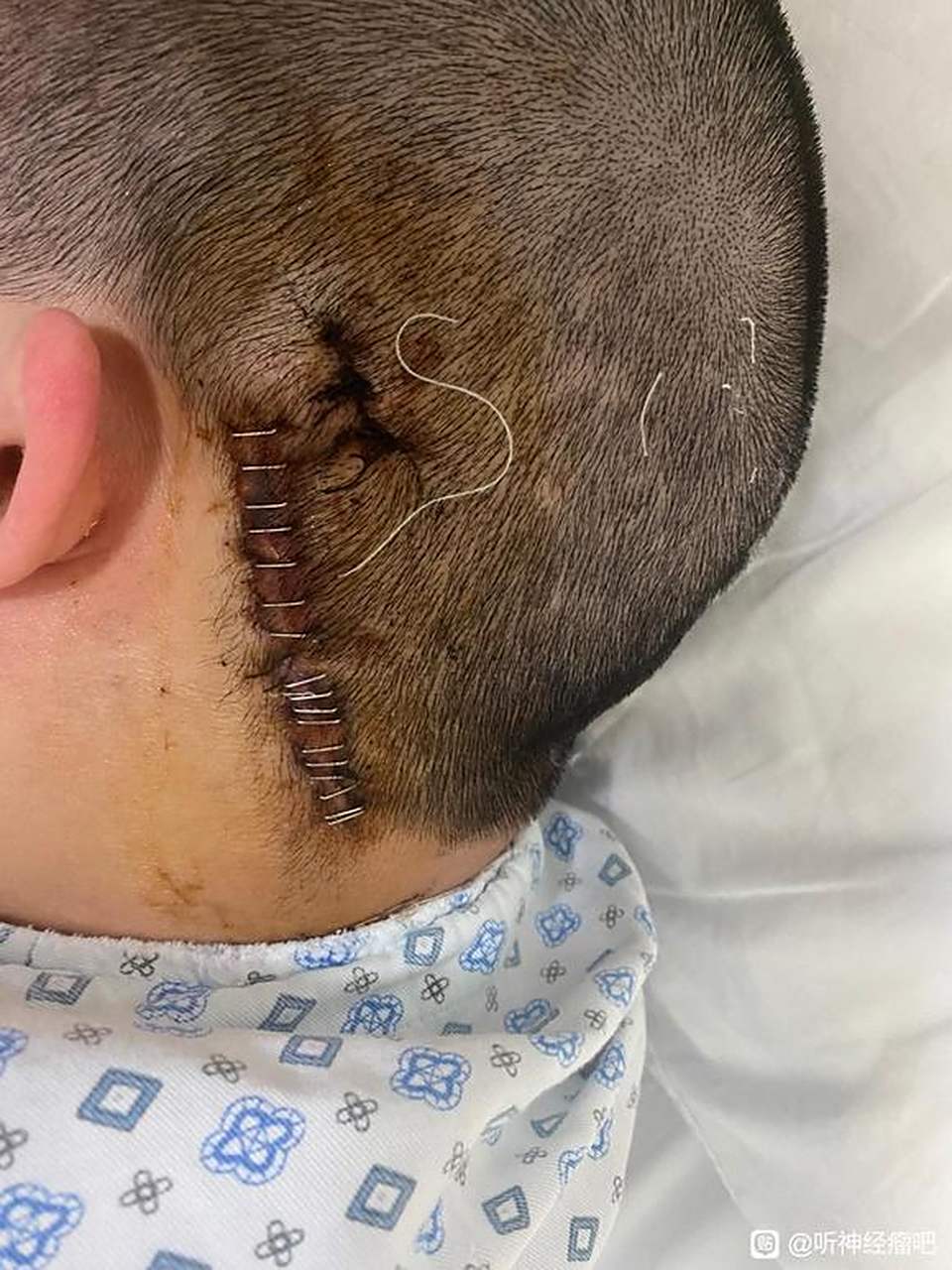 一段神经瘤的治疗过程2 #听神经瘤# #疾病治疗经验# #健康经验笔记