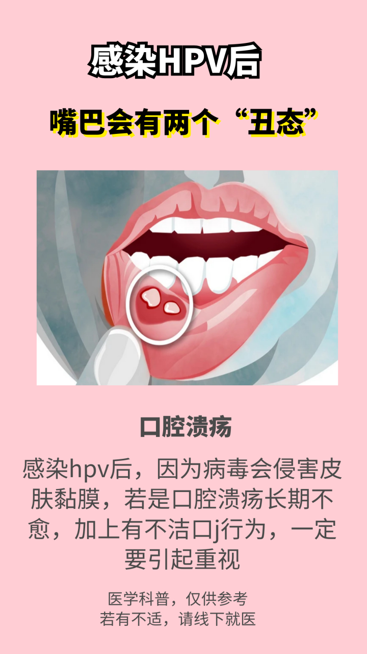 怎样确定口腔内感染hpv图片