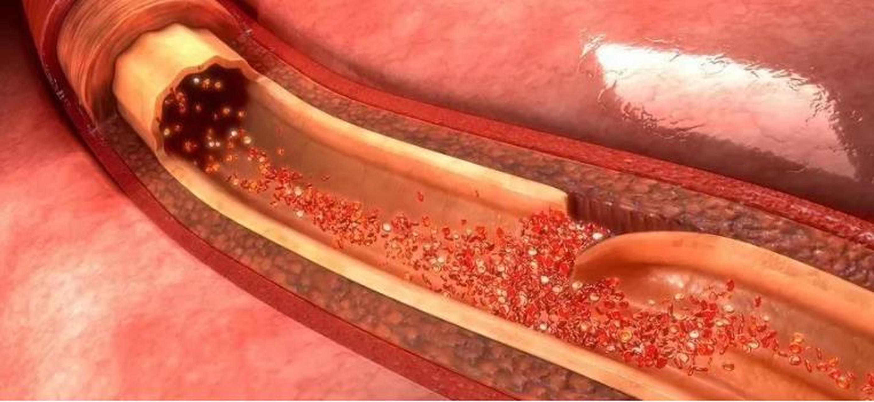 主动脉夹层撕裂是一种紧急情况,可能导致大血管破裂和出血.