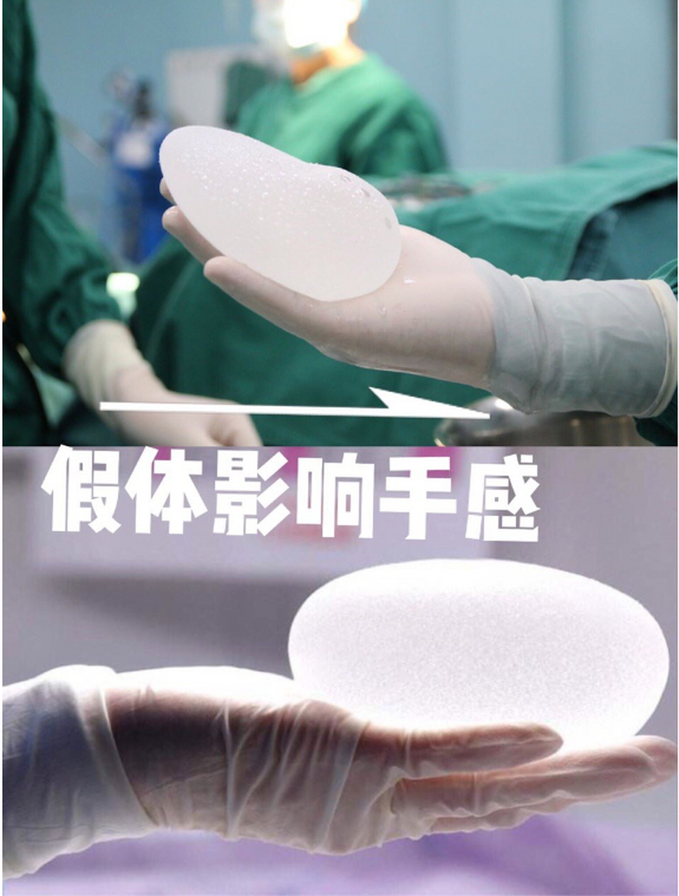 我们隆胸所植入的假体,满足我们需求的情况下选择最小的假体.