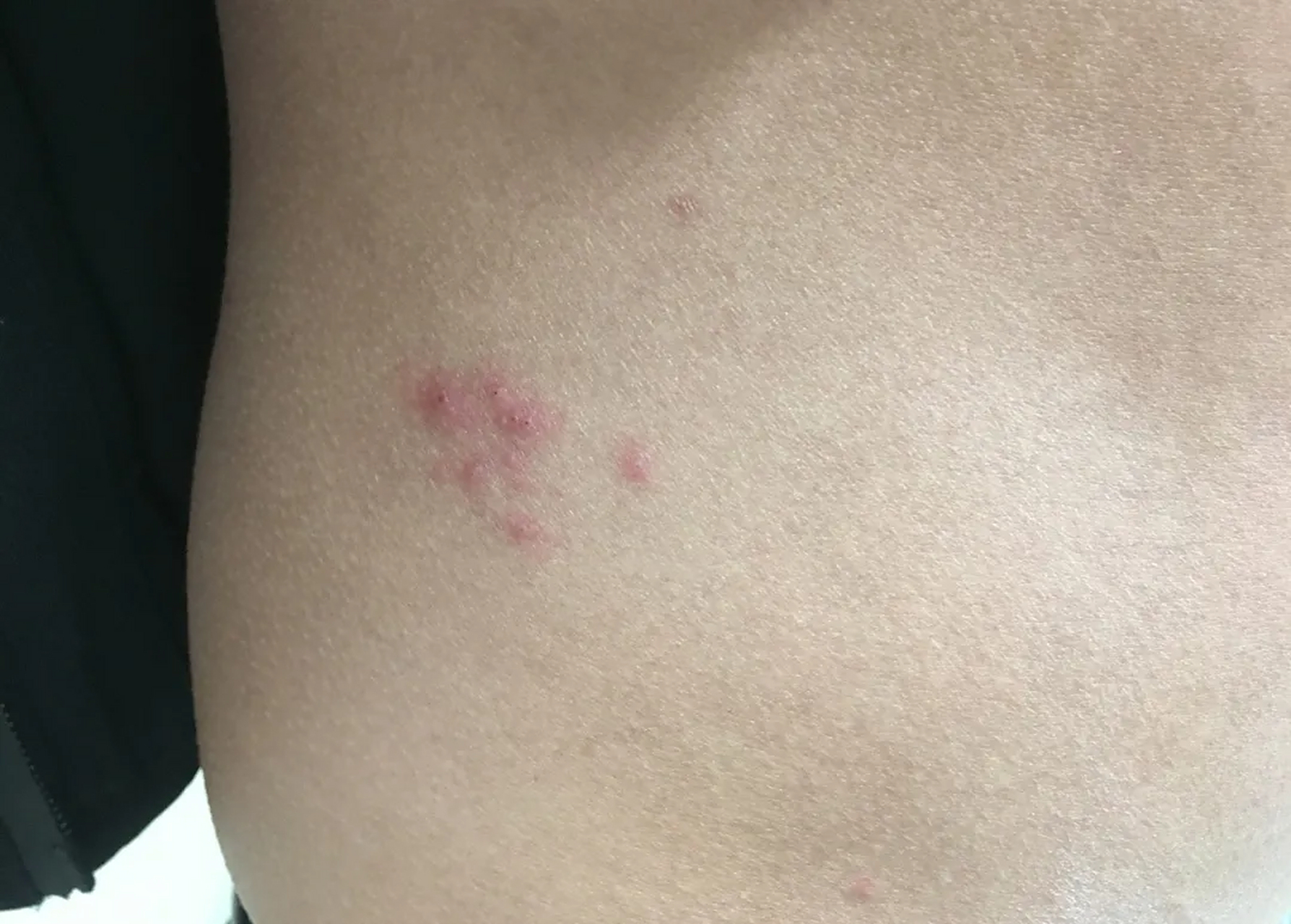 虫咬皮炎大多数想图一这种比较典型, 红肿明显,一般就中间会有个