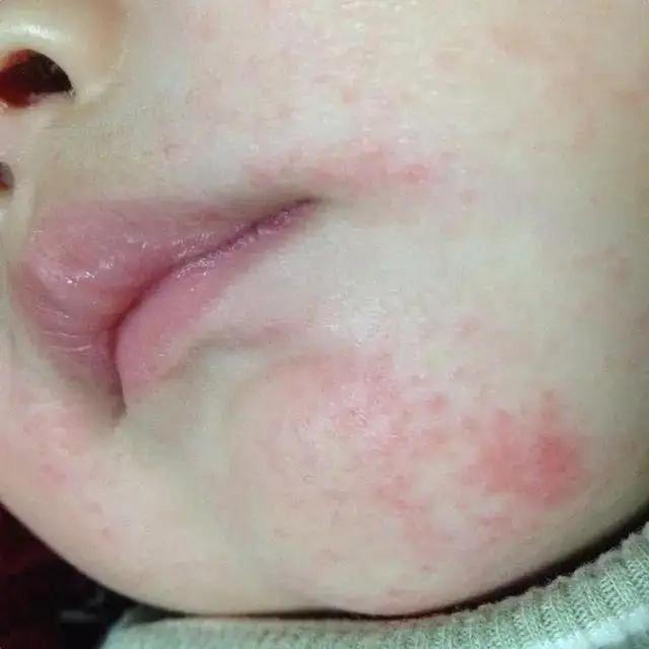 口水疹该如何治疗?