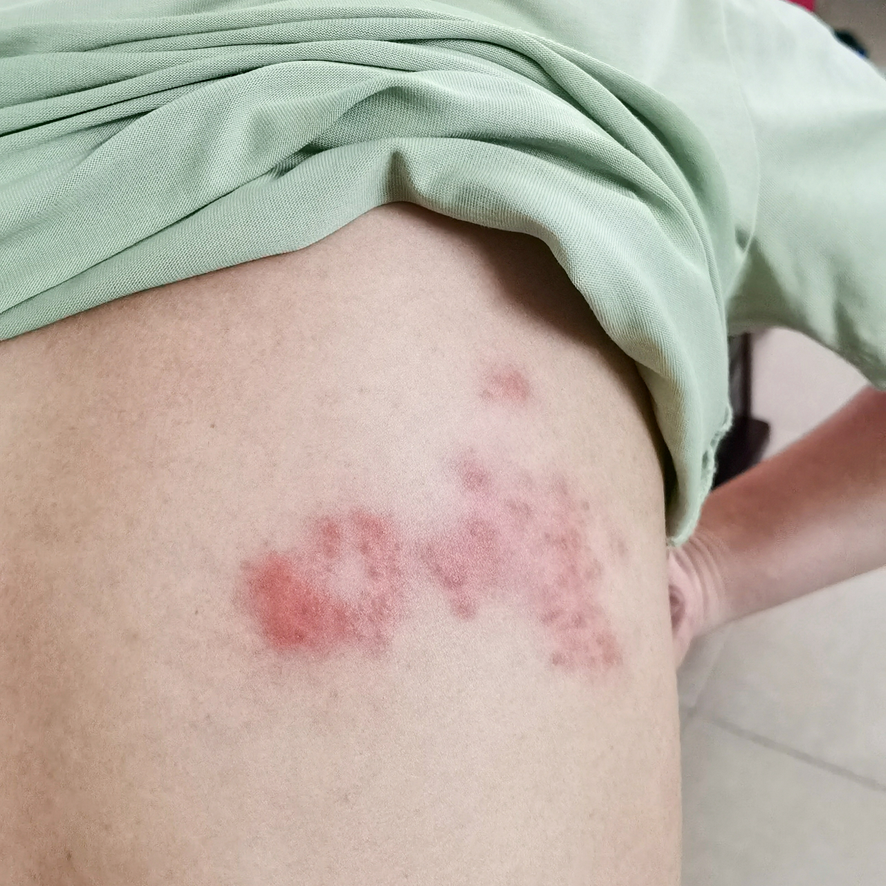 长了带状疱疹真的让人痛不欲生啊!