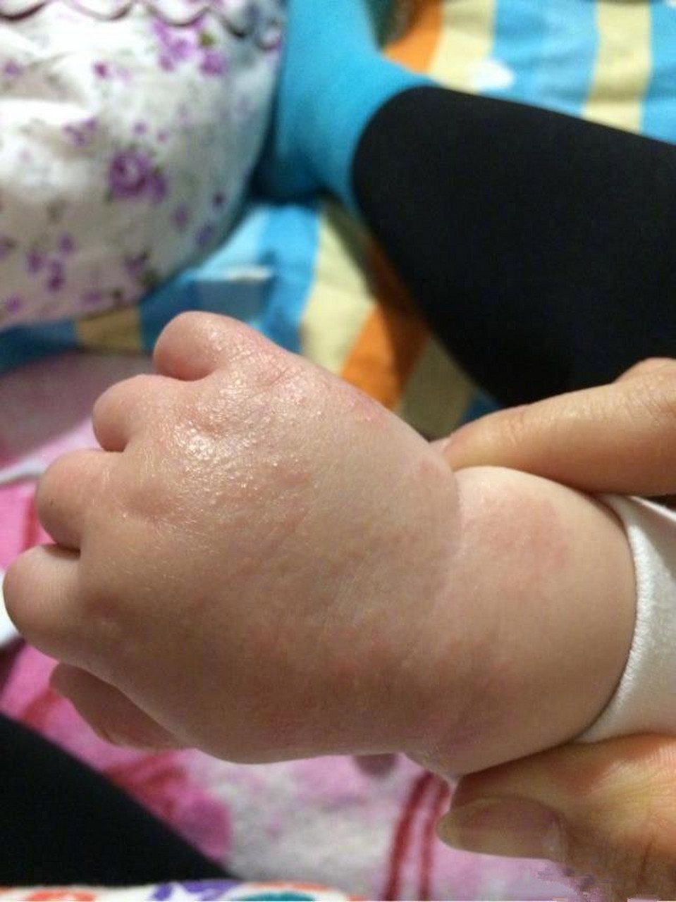 汗疱疹属于湿疹的一种,一般出现在手上,轻微的出现在手指侧面,明显