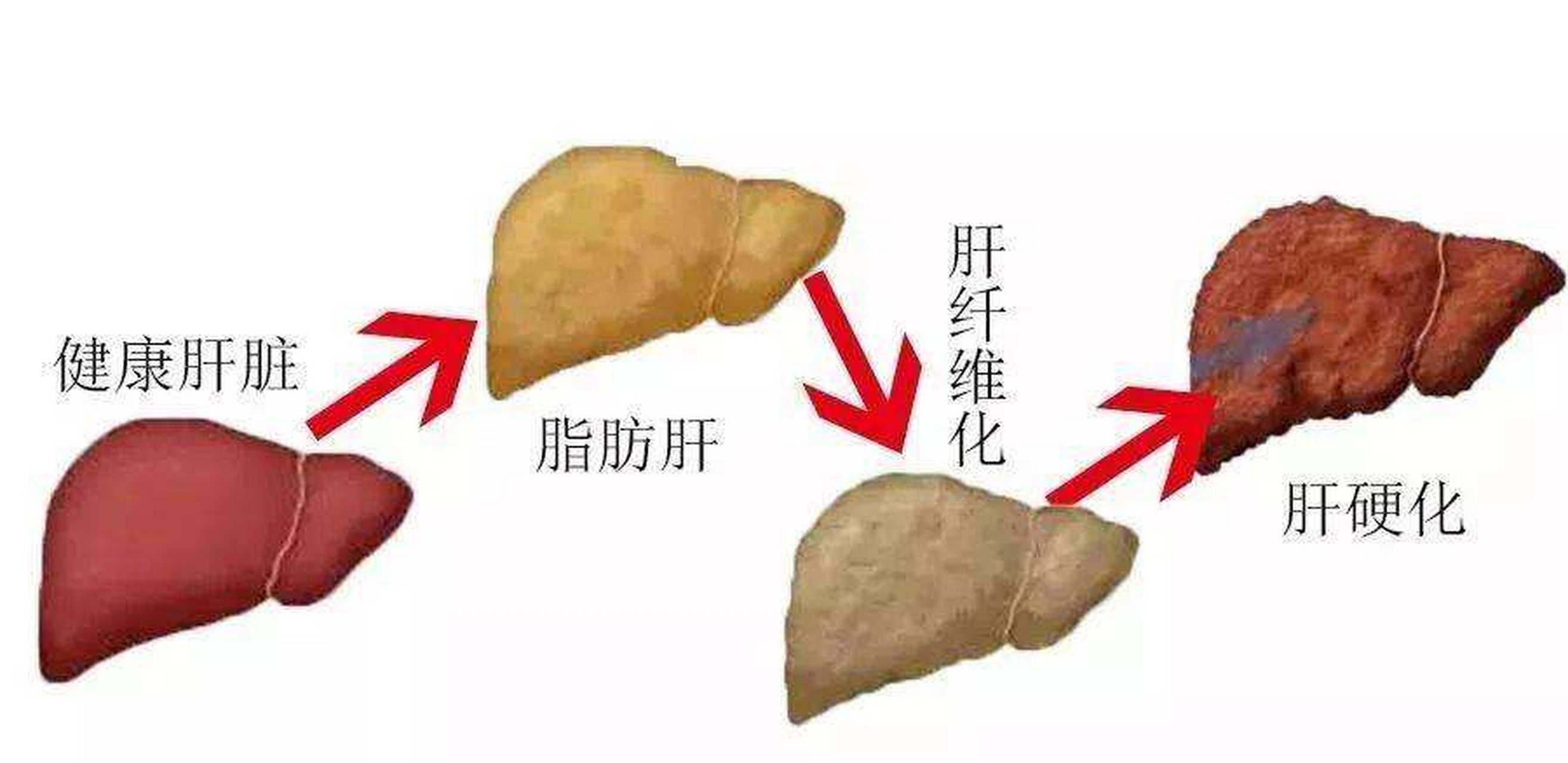 肝硬化并发症图片图片