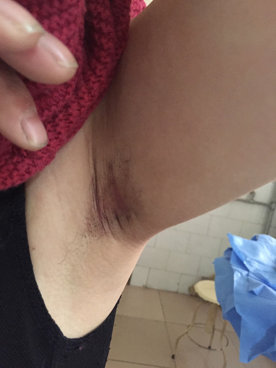 狐臭会传染给别人吗?  不会.