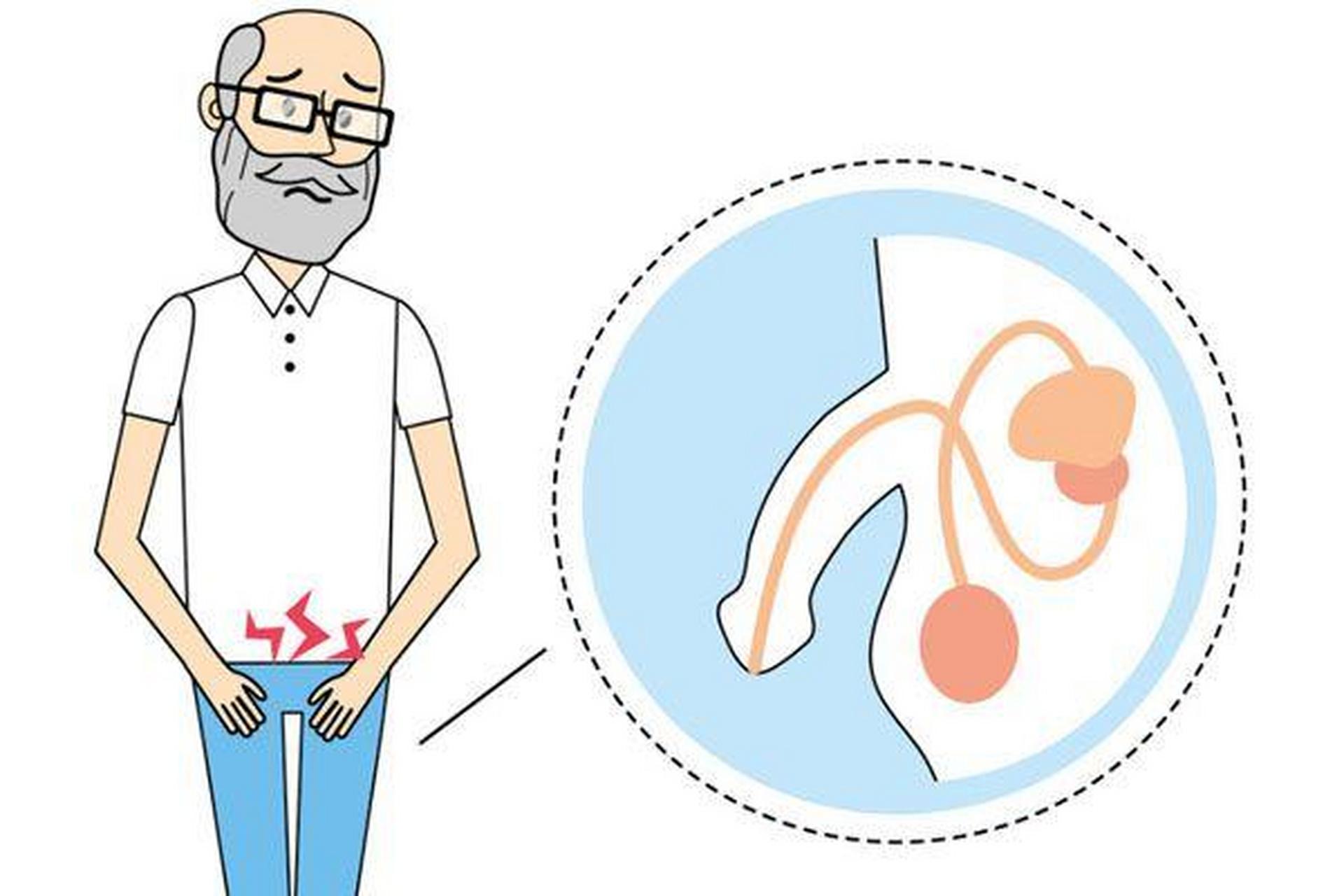一般症状是尿道口红肿,有脓性分泌物,沿尿道可有压痛.