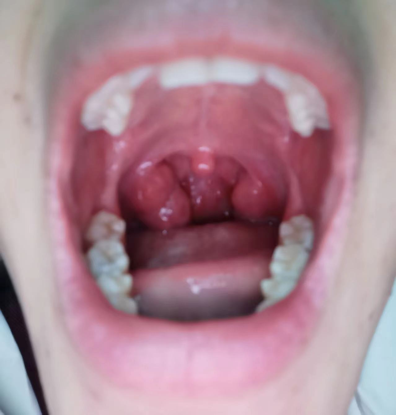 孩子扁桃体肿大,分享几味中药,消肿散结