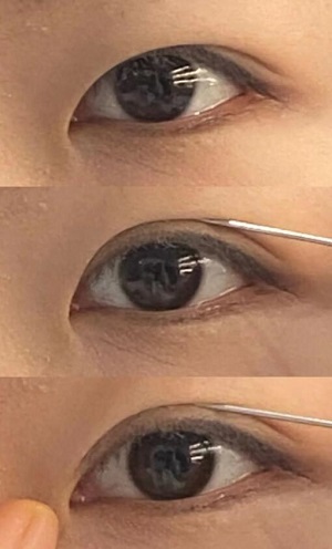 医院说我可以通过开眼角手术改善,天生外眼角就很开的女生