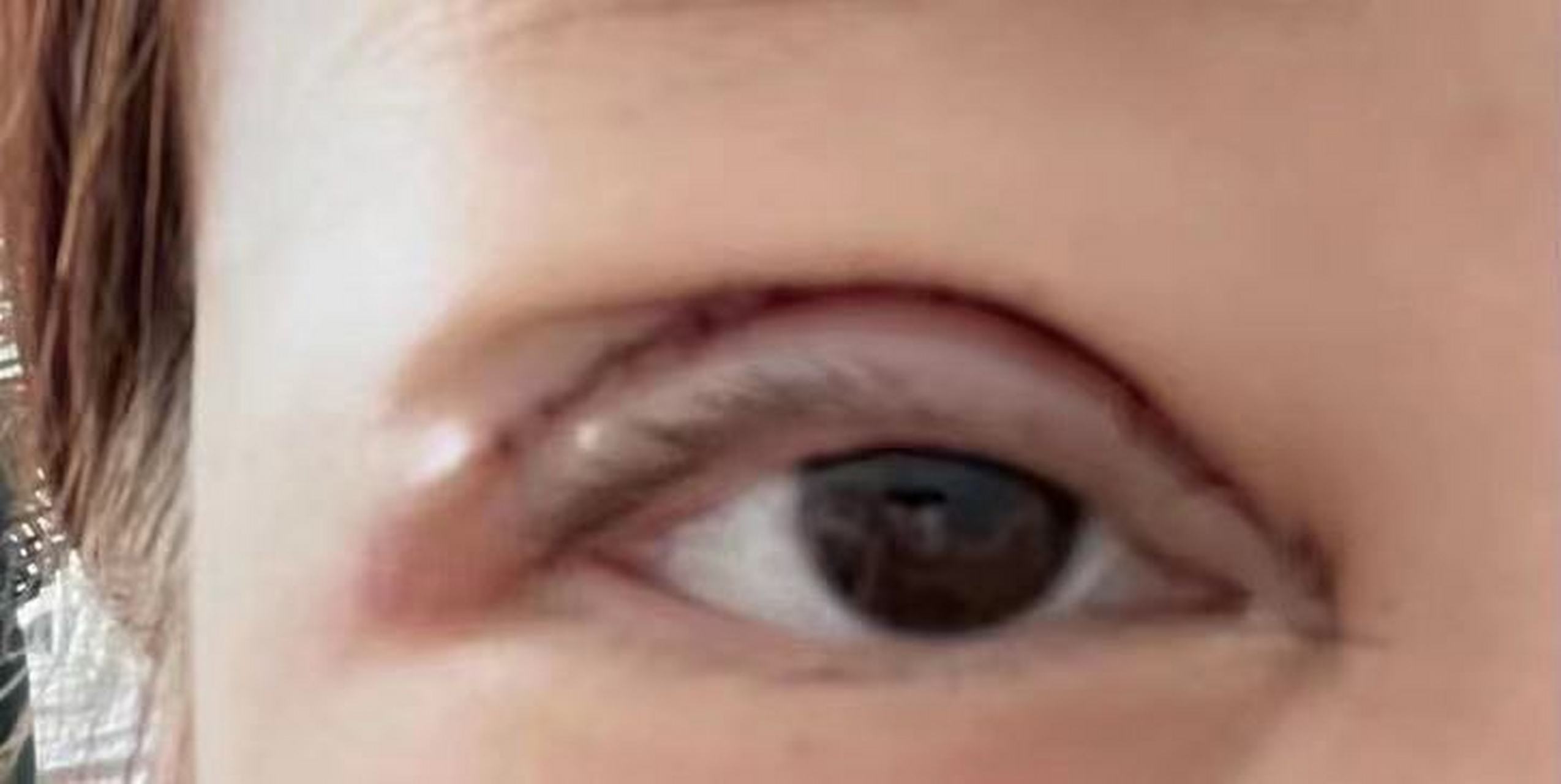 做完双眼皮后,眼尾出现分叉的原因如下: 一:多:眶部组织去除较多,向眼