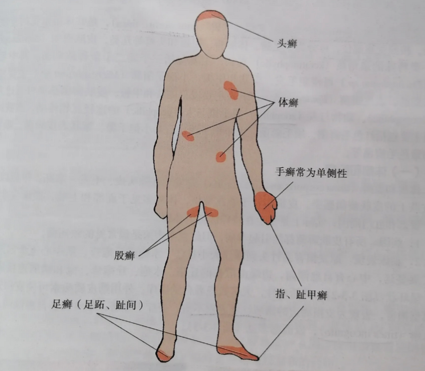 皮肤病的种类图片真菌图片