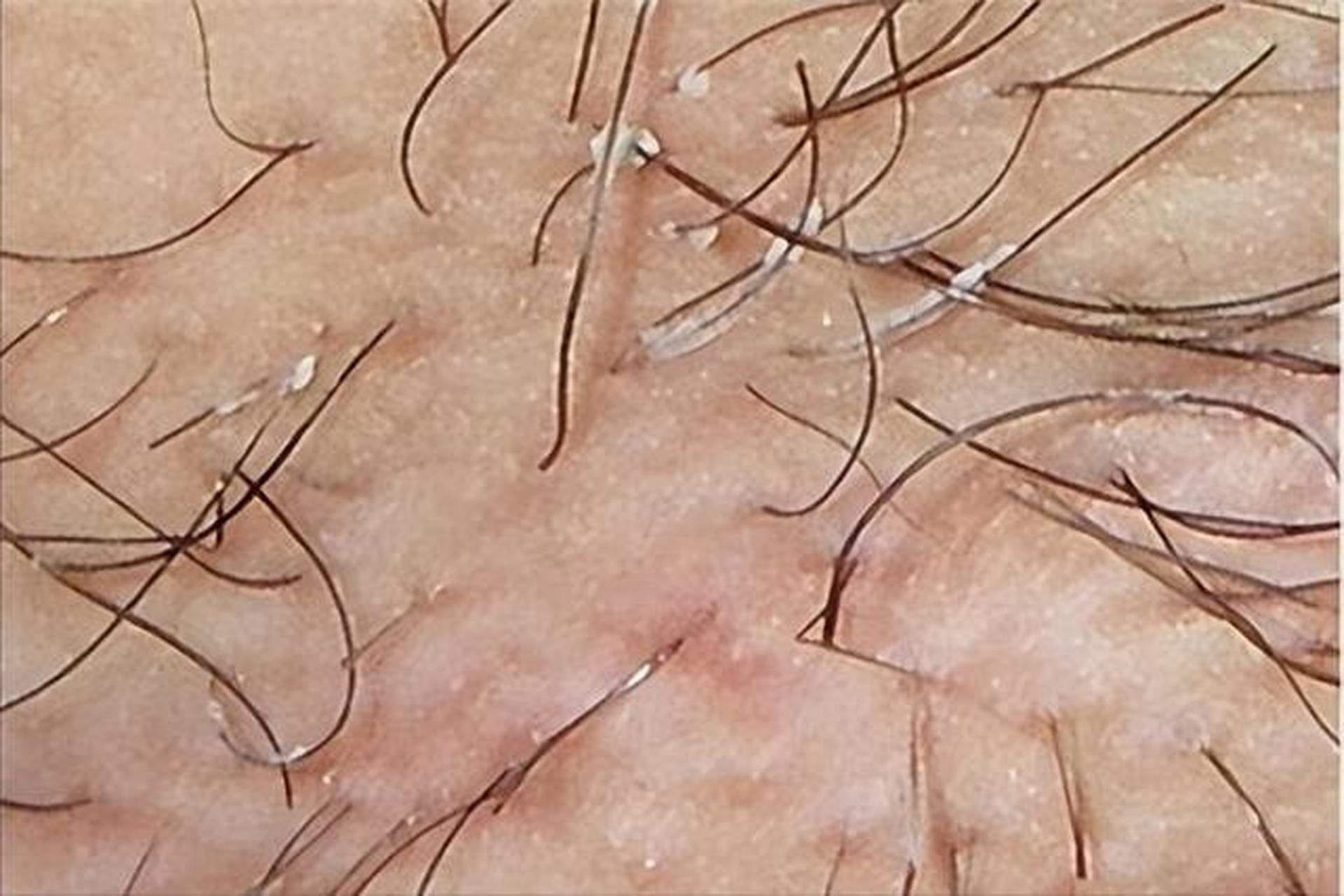 " 腋下白色的分泌物临床上通常叫腋毛癣,是由纤细的棒状杆菌引起的,是