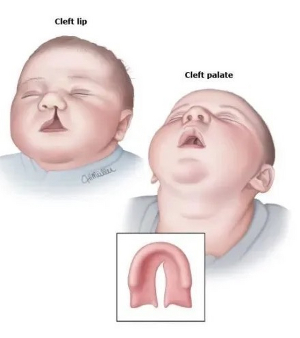 先天性嘴巴畸形图片图片