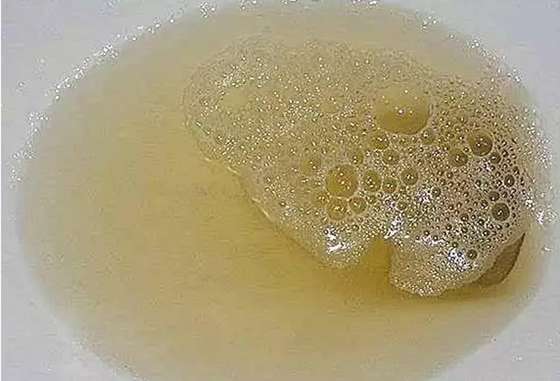 尿里有泡沫是蛋白尿吗?经常有粉丝问我,我的尿里有泡沫,是不是蛋白尿?