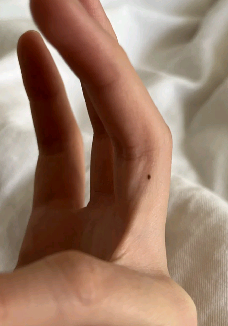 手指头上长出了一个痣,是什么意思,"手上有志"吗