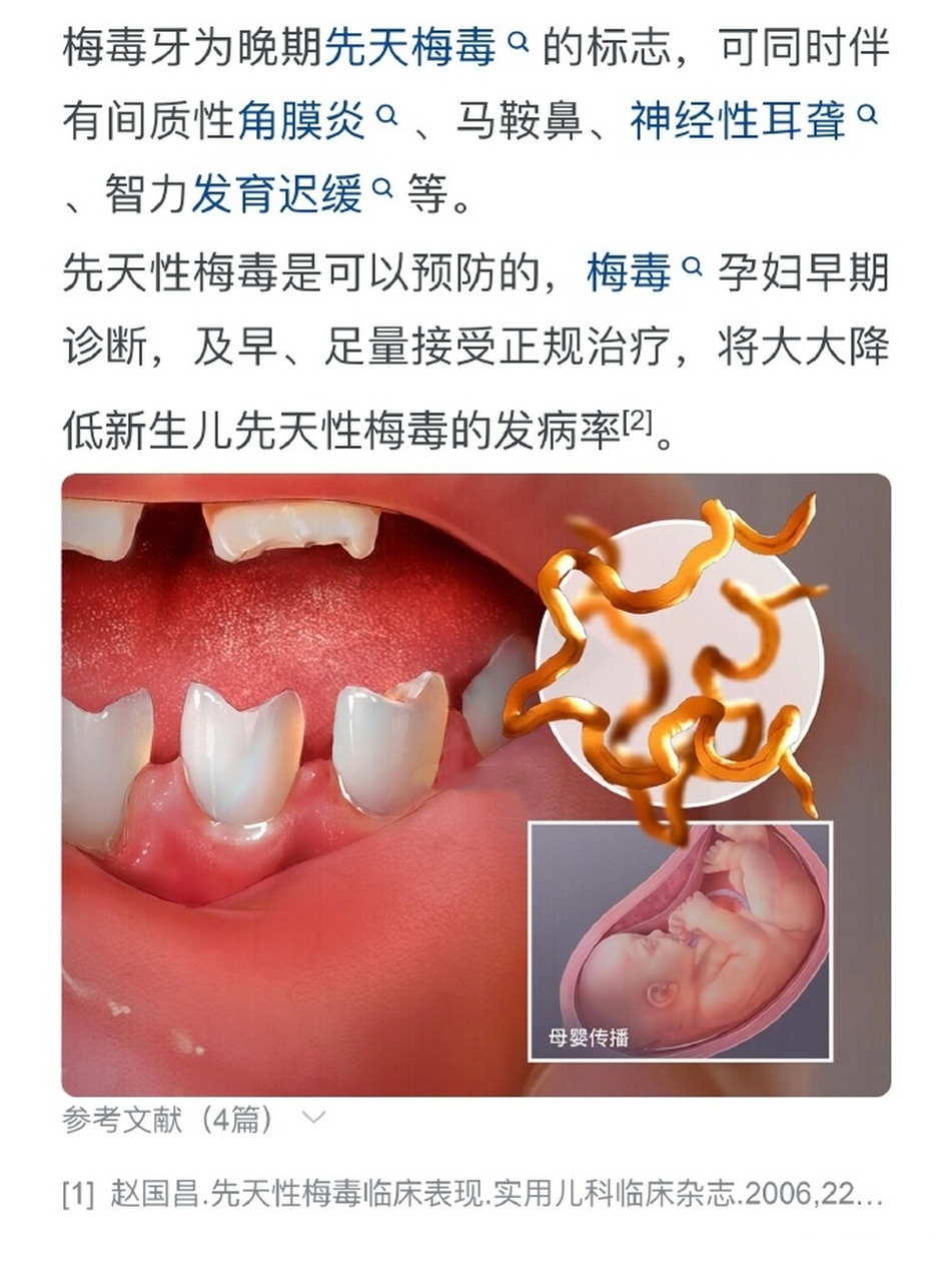 梅毒牙齿半月形的图片图片