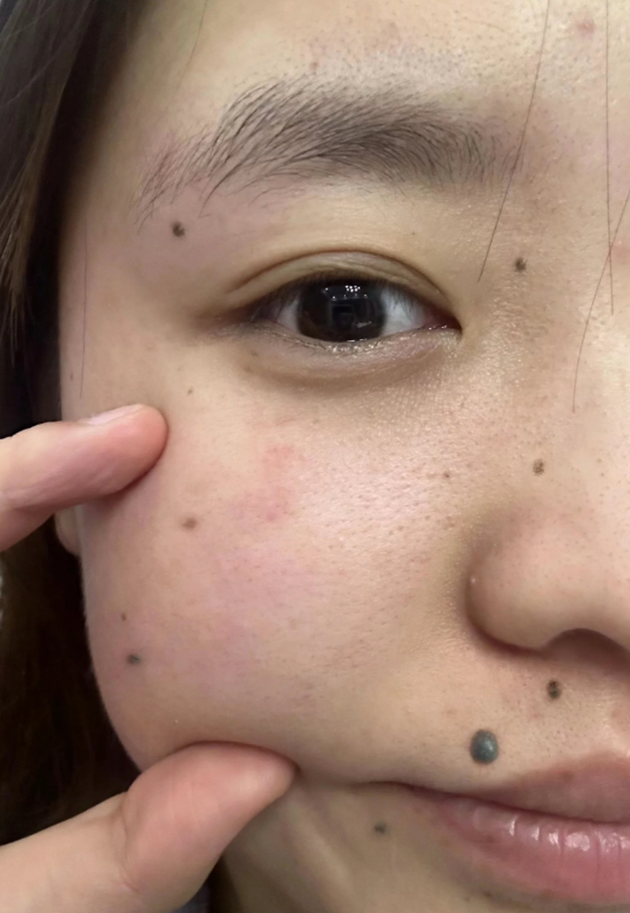 医美科普挑战赛#  凸起的黑痣是一种常见的皮肤问题,给人们带来一定