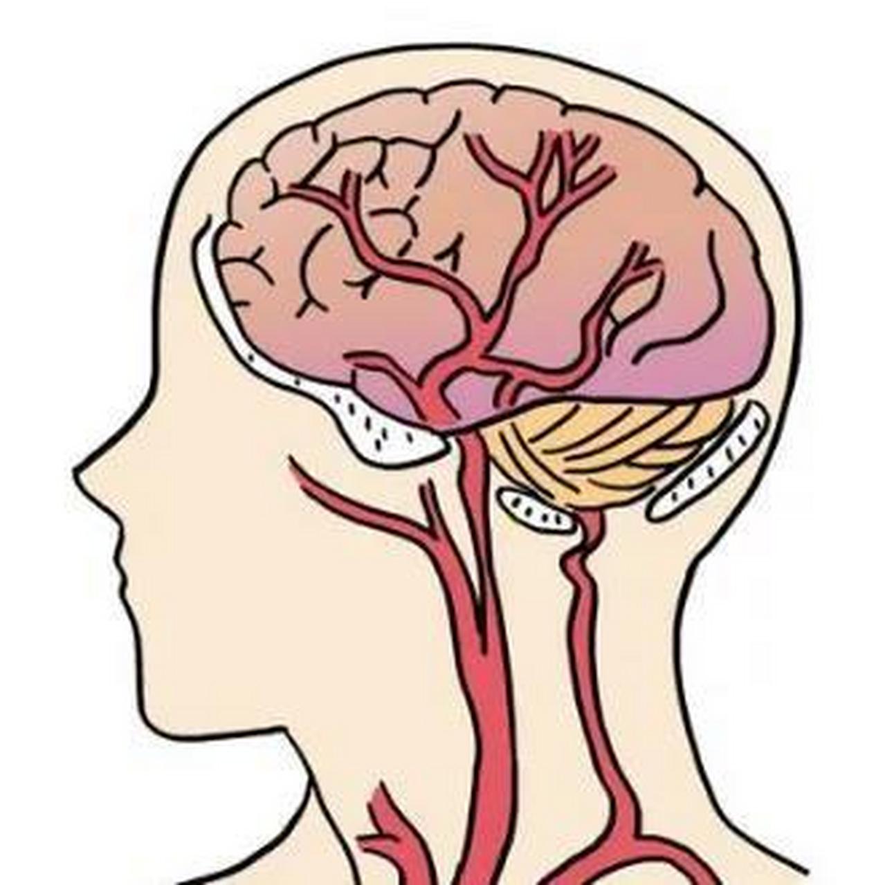 脑梗是一个高发病率,高死亡率,高致残率和高复发率的疾病,怎样能够