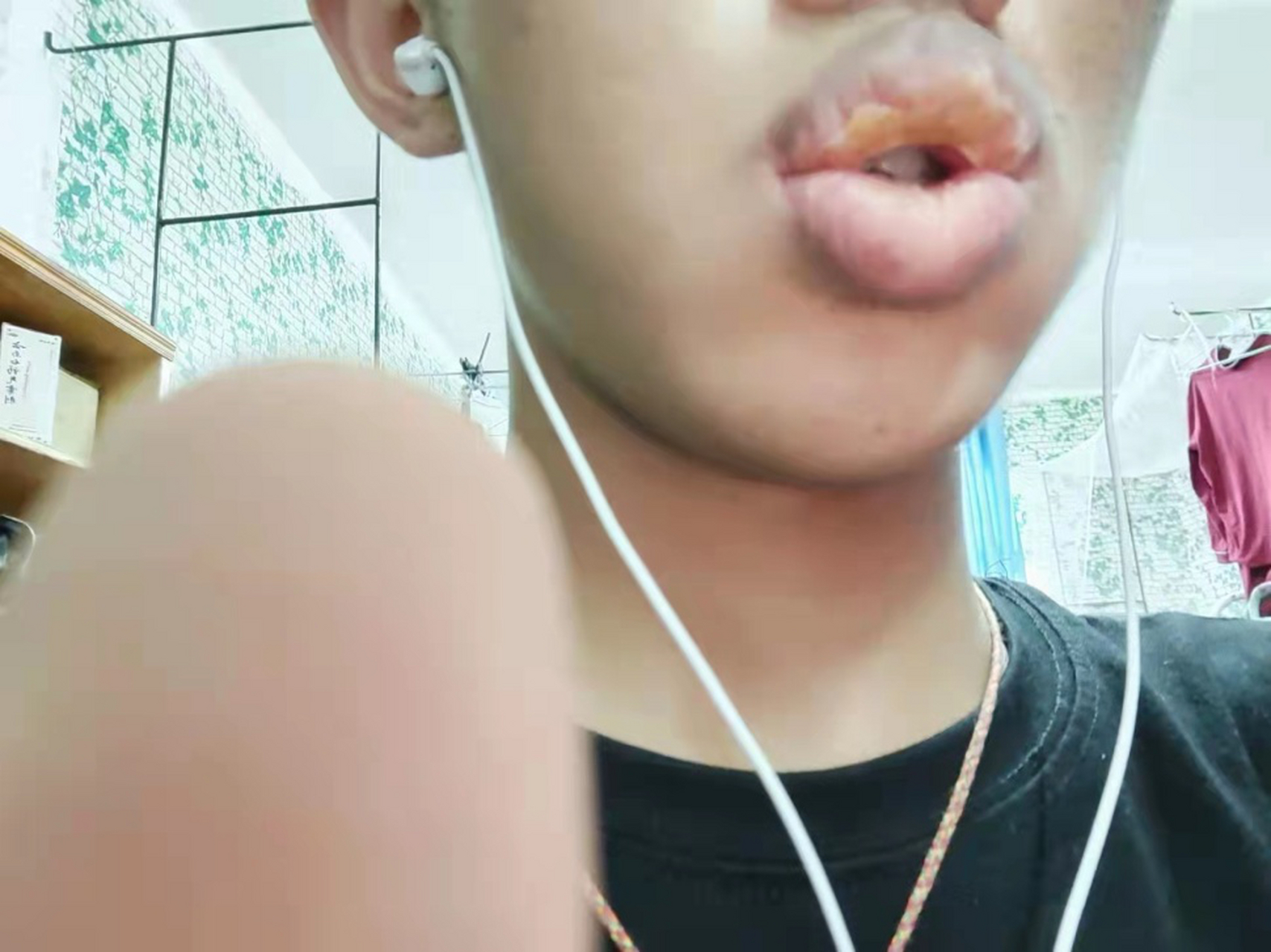 嘴唇有炎症,嘴都闭不上了,天天往外流口水 这是我之前的一个门诊案例