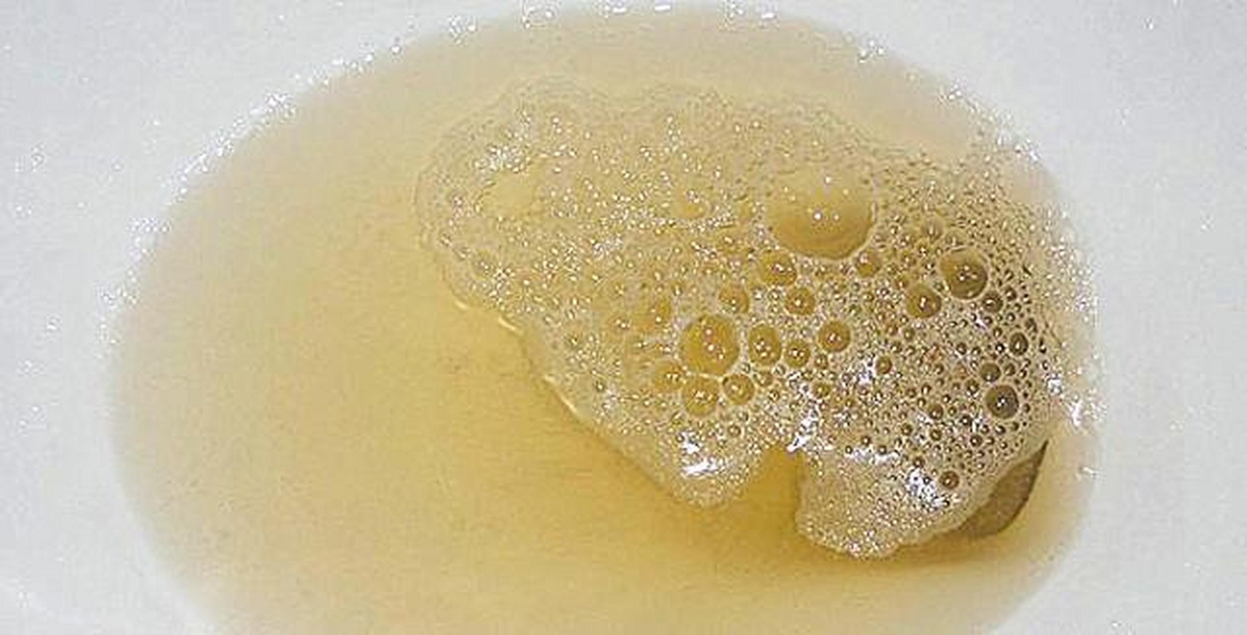 小便有泡沫说明什么问题?