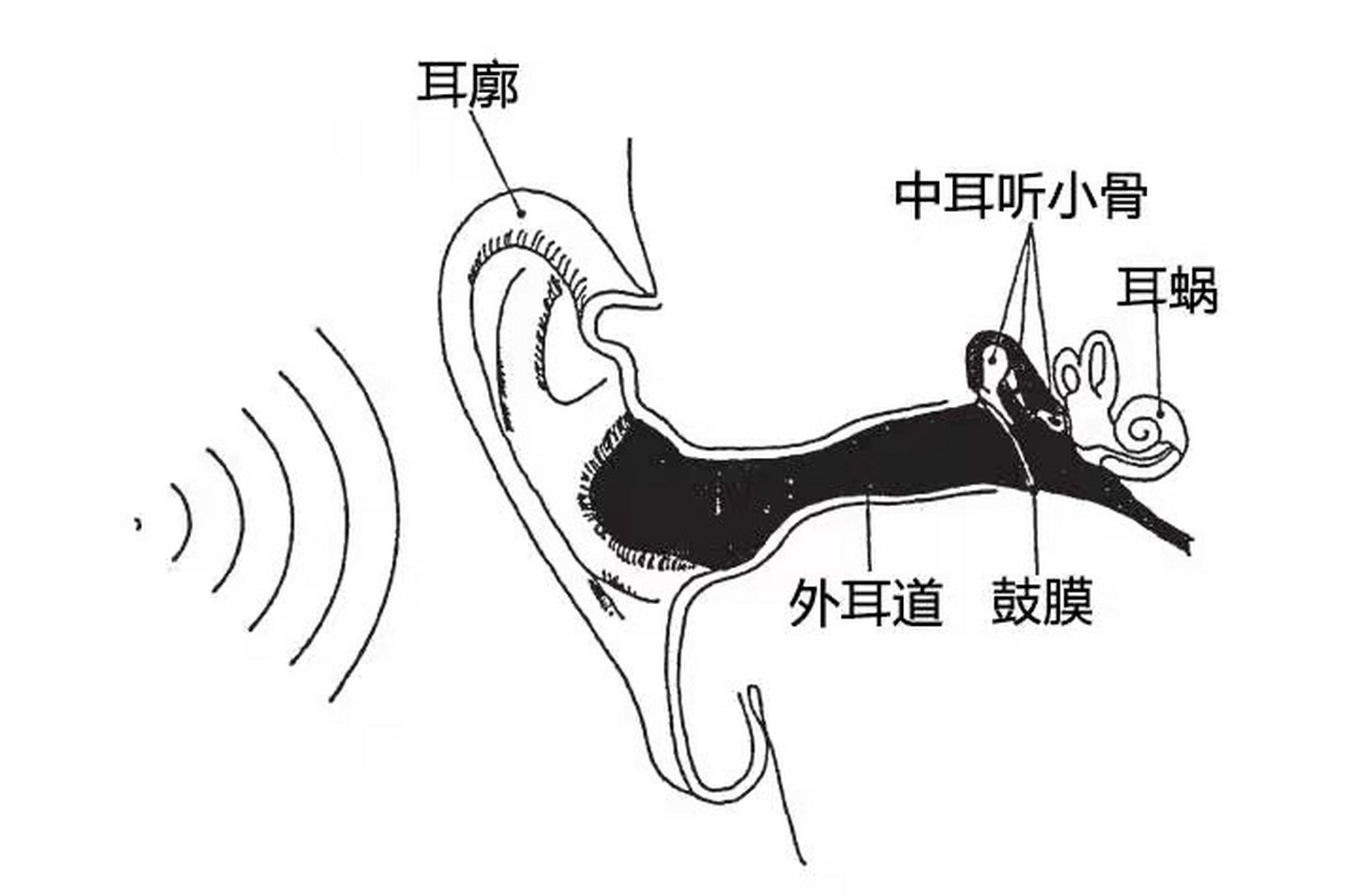 小耳畸形中,狭窄耳道比闭锁更好吗?