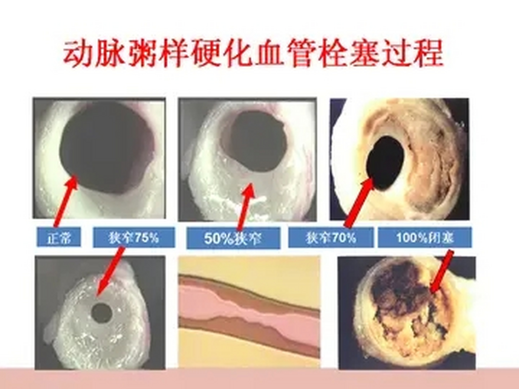 教你动脉硬化指数计算方法,≥4就要注意了!