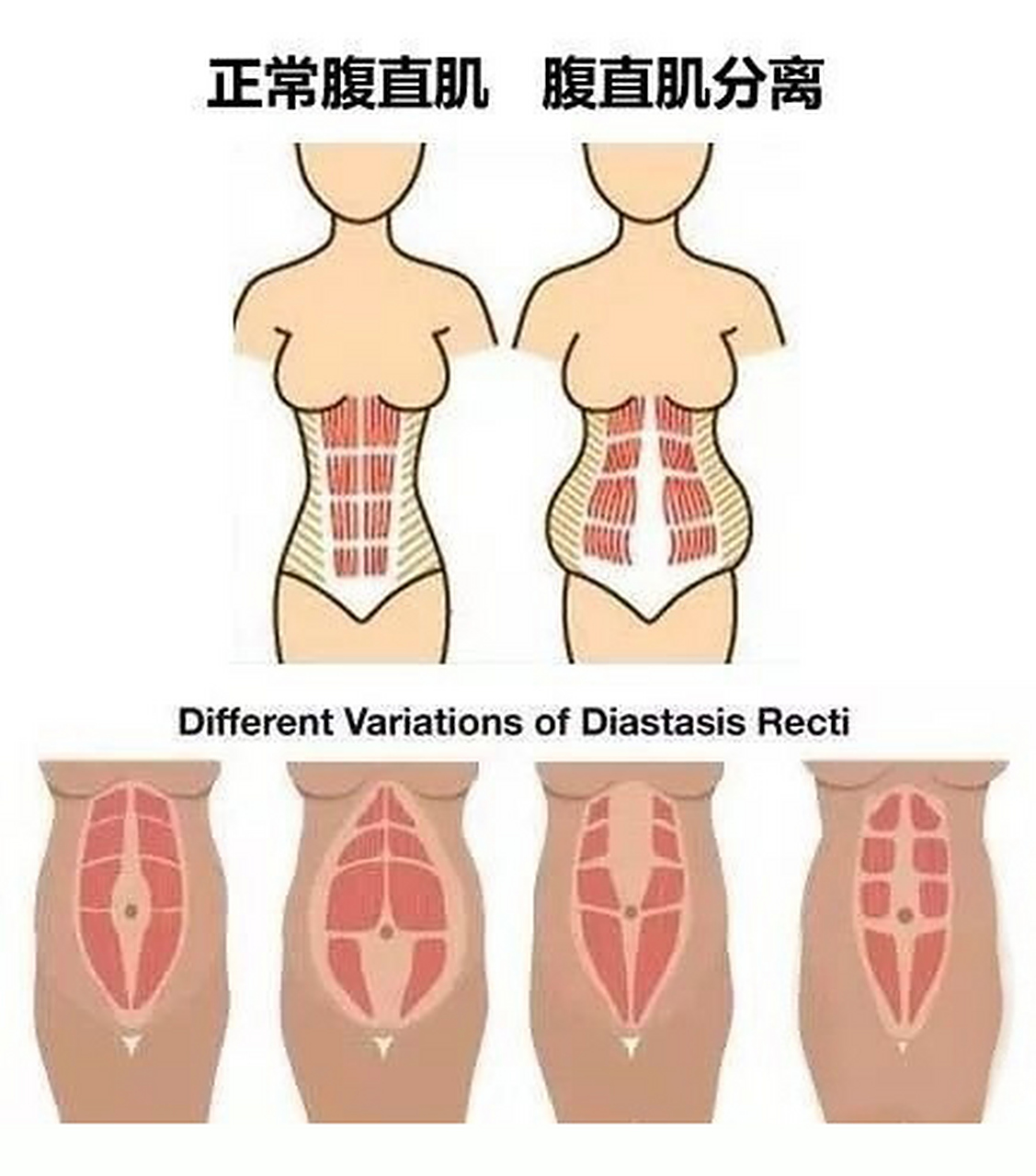 产后腹直肌分离会造成腹部变大,无法复原,肚子处于松垮的状态,还会