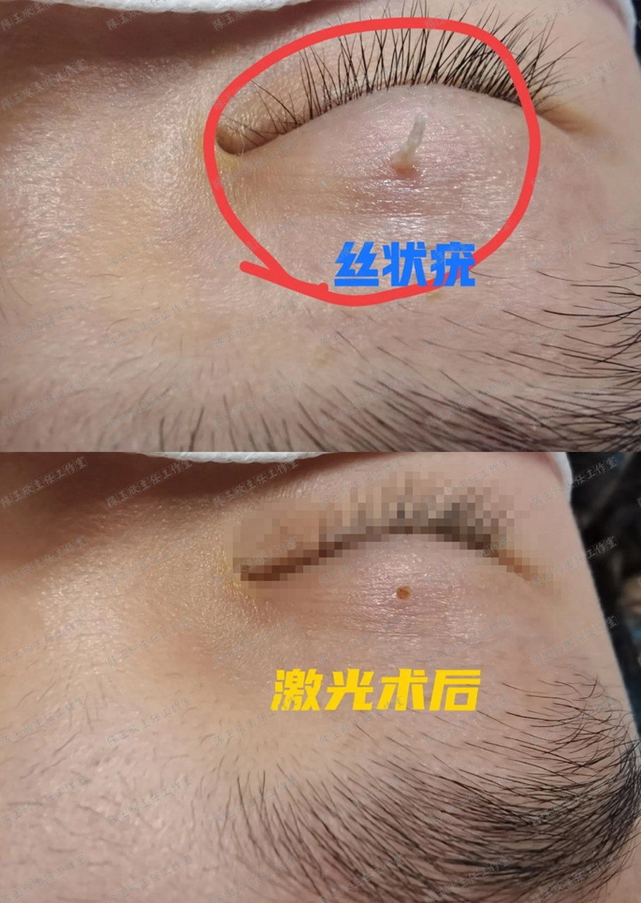 小患者眼皮上长的这个细长的小肉揪,是一种【丝状疣】!