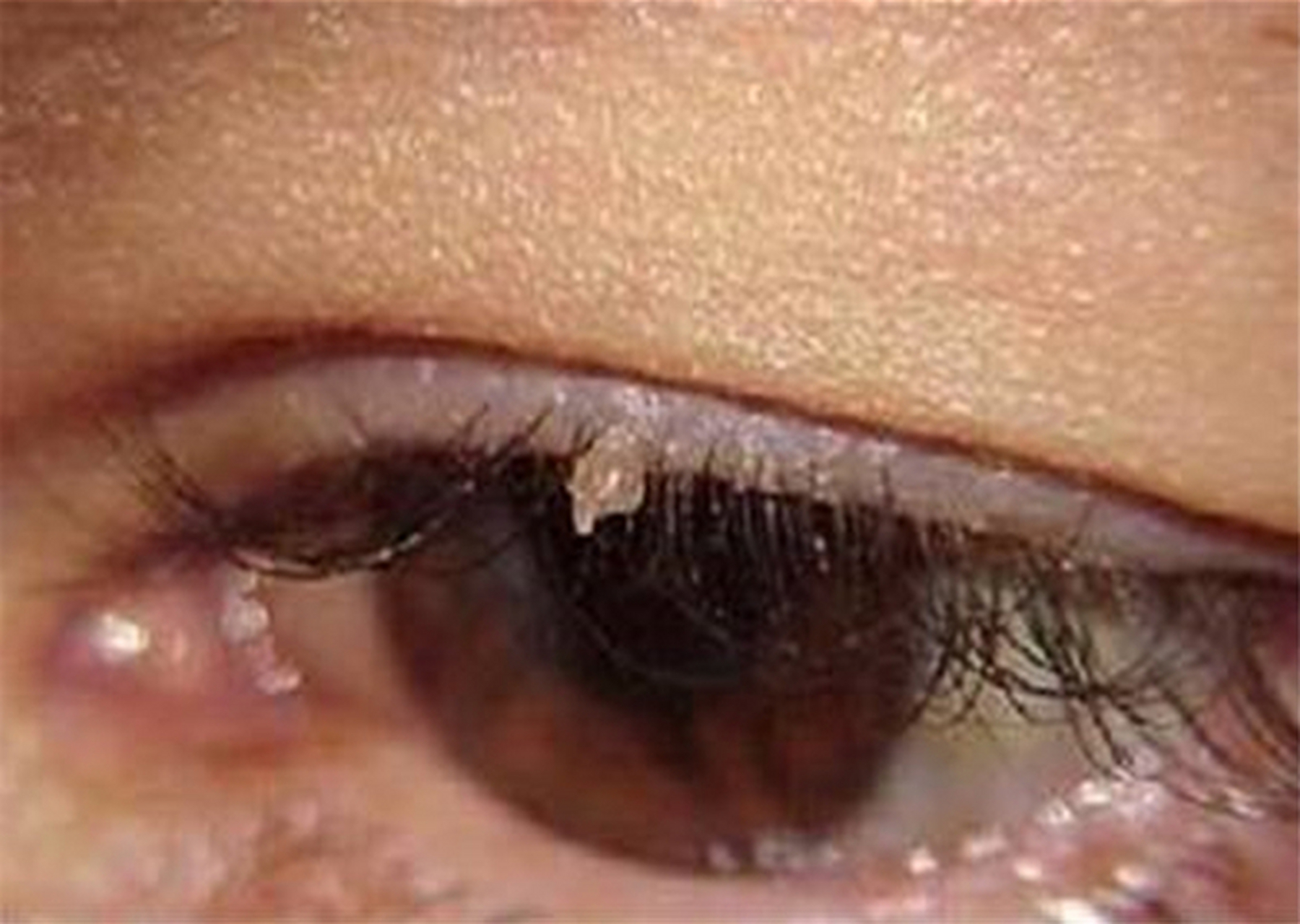 疣是由hpv感染引起的一种皮肤疾病,常见于脸部,眼睑周围,嘴唇,脖子