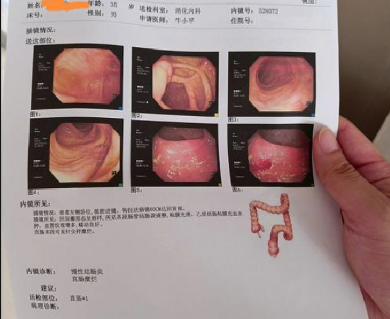 结肠炎疼痛部位及症状表现:  结肠炎是一种常见的肠道疾病,其疼痛部位