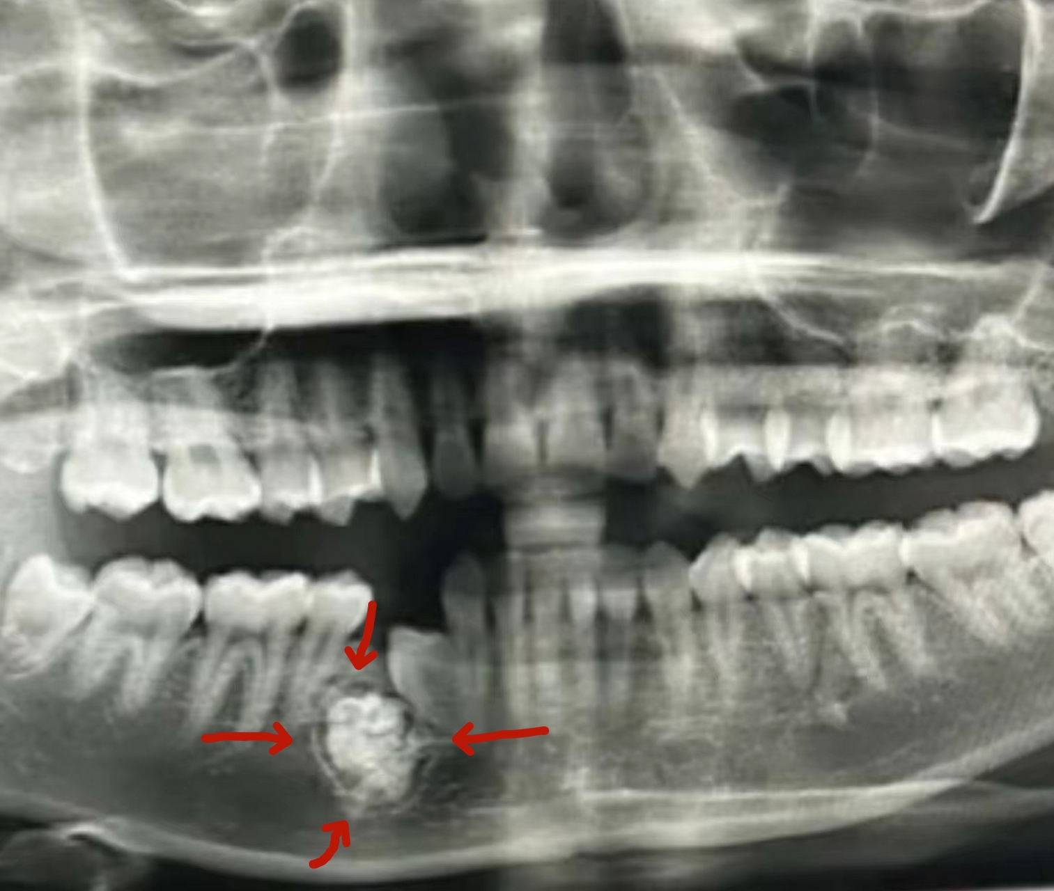 什么是牙瘤?生长于颌骨内,由一个或多个牙胚组织发育异常形成