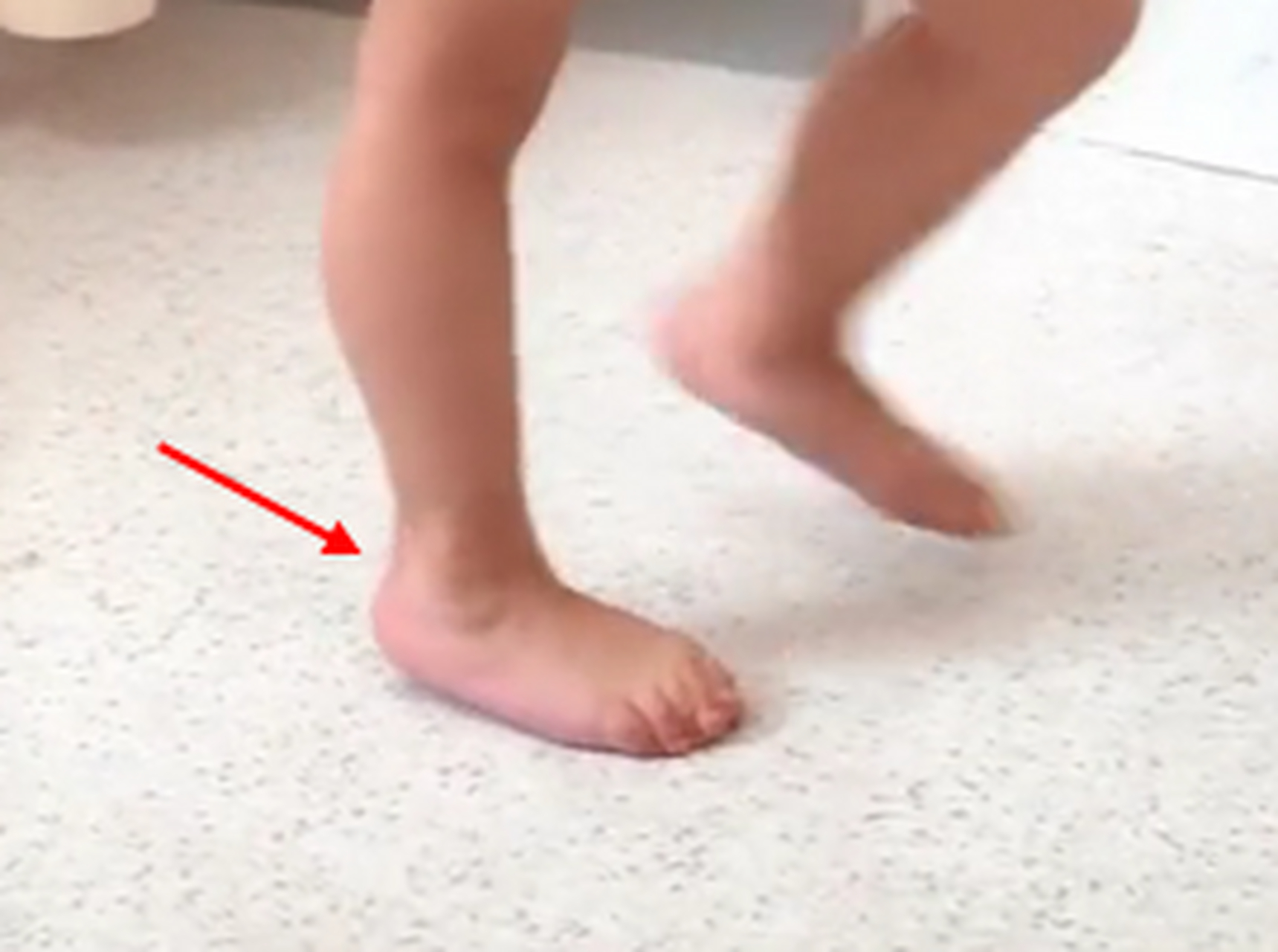 孩子走路总踮脚,脚跟不着地,跑步姿势奇怪,老是摔跤!